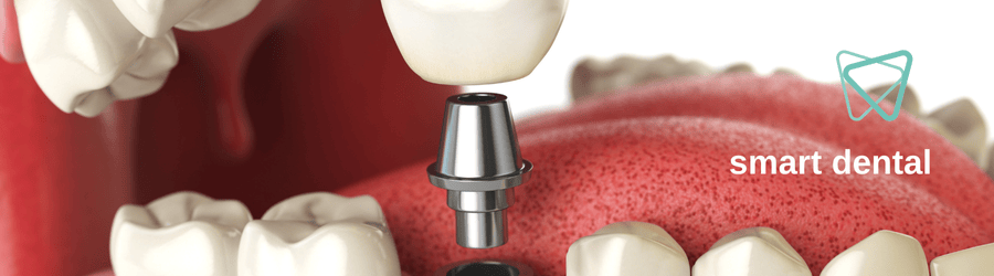 מונחים חשובים בתחום שתלים ברפואת שיניים