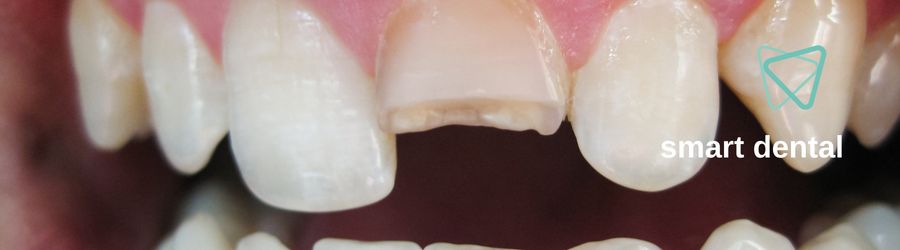 תיקון שיניים שבורות מדריך מלא לטיפול ושיקום